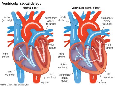 lower left ventricular valve.